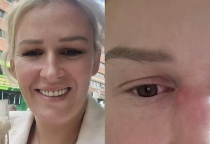 Tumor agressivo escondido em um pequeno caroço no nariz mudou a vida de Mel Frisby -  (crédito: Reprodução/TikTok @melfrisbyofficial) -Tumor agressivo escondido em um pequeno caroço no nariz mudou a vida de Mel Frisby -  (crédito: Reprodução/TikTok @melfrisbyofficial)