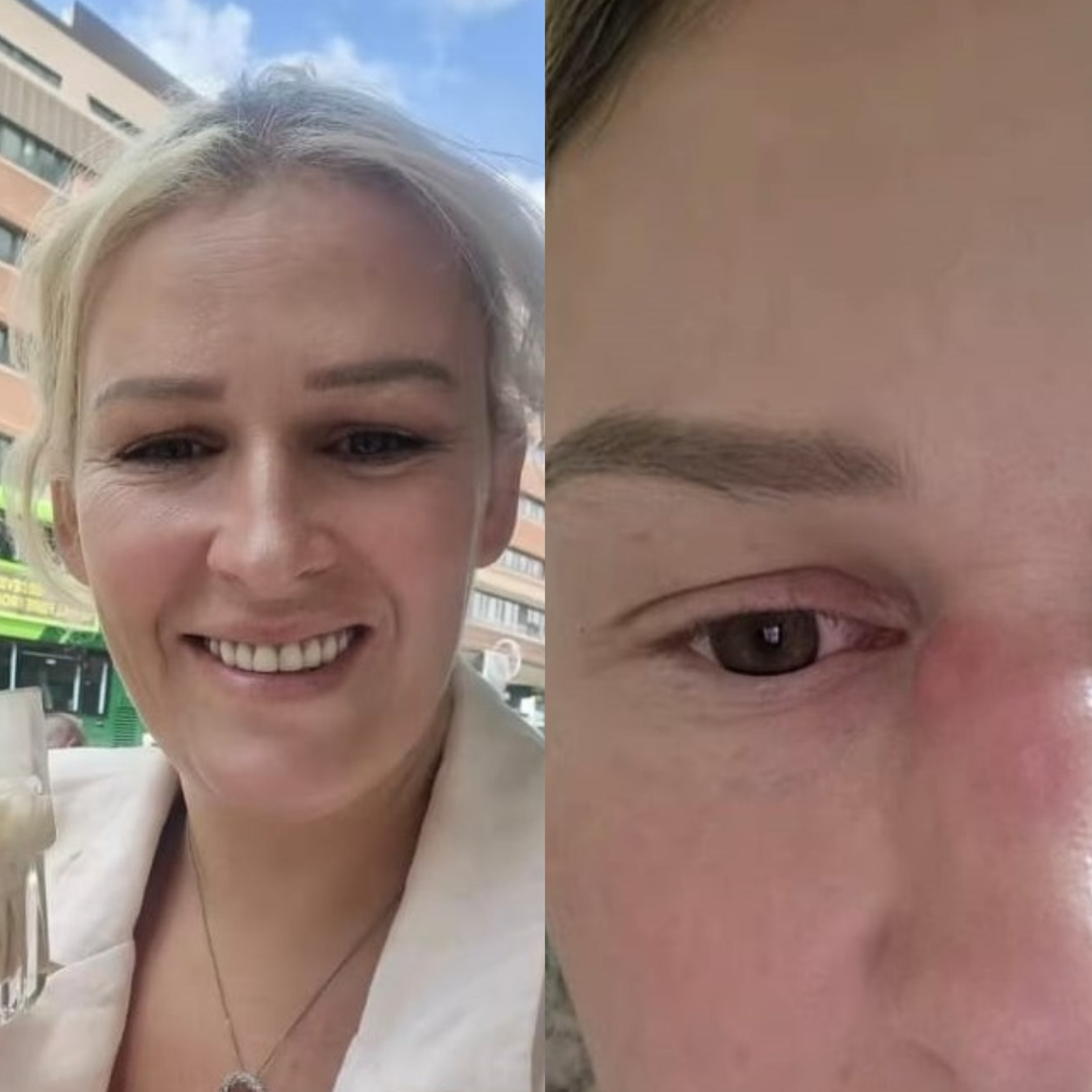 Caroço no nariz revela câncer e muda aparência de mulher: 