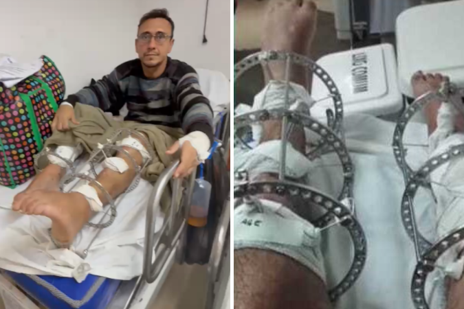 Daniel Marinho Guedes faz uso de fixadores externos circulares nas pernas para tratar lesões decorrentes de um atropelamento - (crédito: Material cedido ao Correio) Daniel Marinho Guedes faz uso de fixadores externos circulares nas pernas para tratar lesões decorrentes de um atropelamento - (crédito: Material cedido ao Correio)