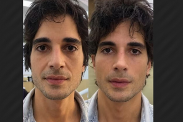 Fiuk antes e depois da harmonização facial, procedimento estético detalhado na reportagem - (crédito: Reprodução/SBT) Fiuk antes e depois da harmonização facial, procedimento estético detalhado na reportagem - (crédito: Reprodução/SBT)
